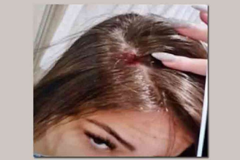 Gabriela exibe ferimento na cabeça –