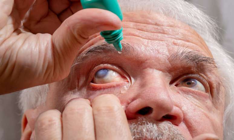 Efeito do CBD no organismo pode ajudar a reduzir o principal fator de risco para o glaucoma. Mais estudos são necessários -