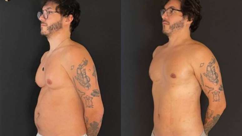 Eliezer mostra antes e depois de cirurgia de redu&ccedil;&atilde;o de mamas.