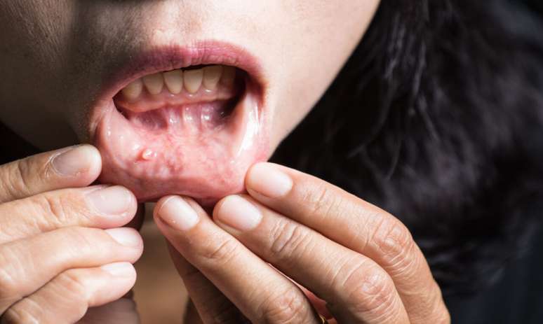Câncer de boca: saiba como detectar a doença precocemente -