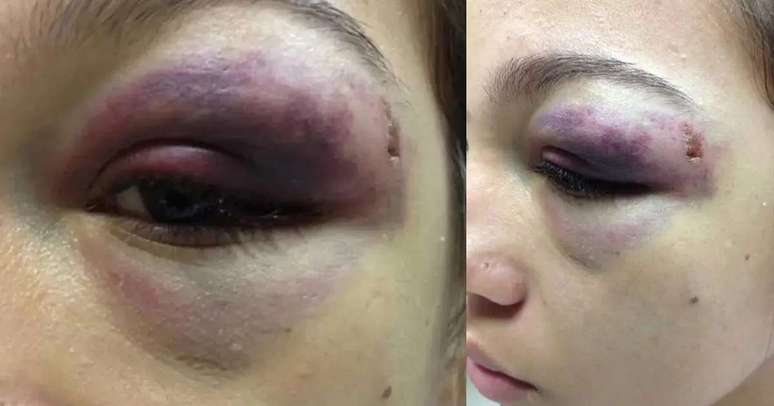 Ferimento de Cristiany em 2013