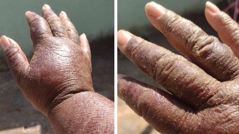 Liliane Feitosa mostra mão e braço com efeitos da alergia ao níquel, substância presente no Essure