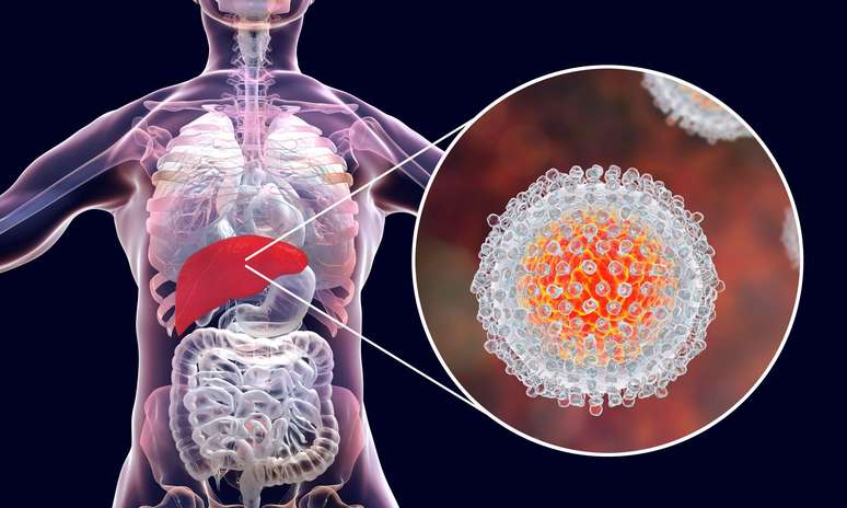 Infecção por hepatite C: Ilustração mostra o fígado e uma visão aproximada dos vírus da hepatite C