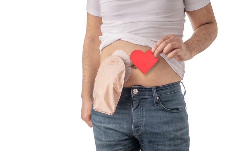 Levantamento do Movimento Ostomizados do Brasil indica que existem mais de 600 mil pessoas com ostomia no Brasil
