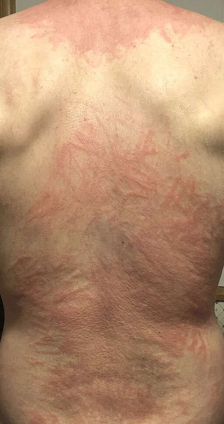Shiitake dermatitis: the skin reaction caused by undercooked mushrooms