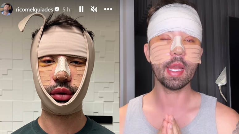 Rico Melquiades compartilhando procedimentos estéticos com internautas. 