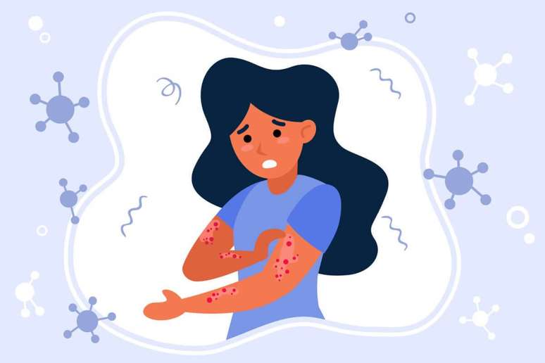Study reveals that psoriasis can affect heart health