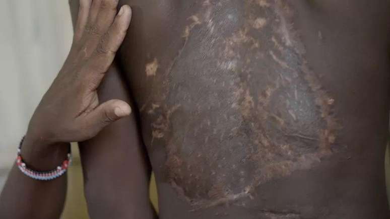 The attack left scars on Caleb's back and legs.