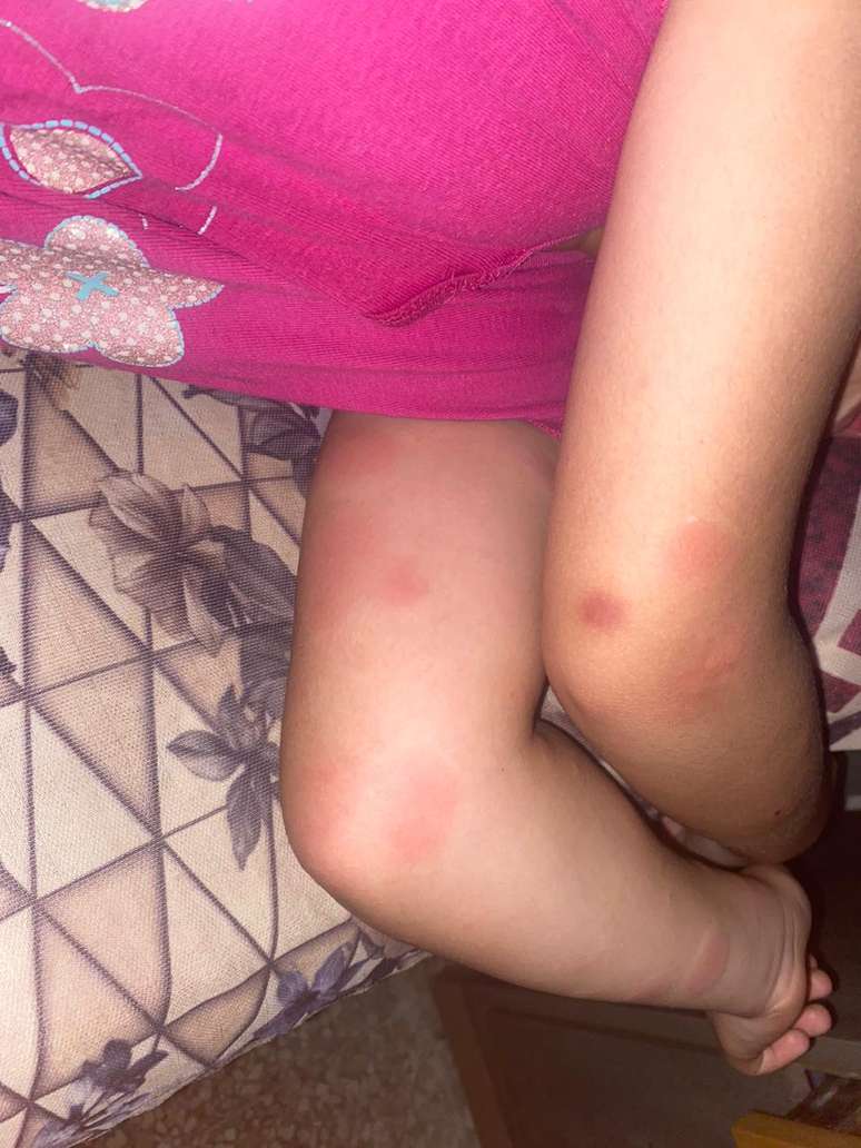 Os braços da filha de Hasan Rabee, que tem cinco anos, com mordidas de insetos
