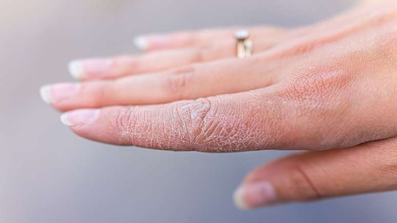 Veja como certos componentes podem ajudar a tratar as mãos ressecadas - Shutterstock