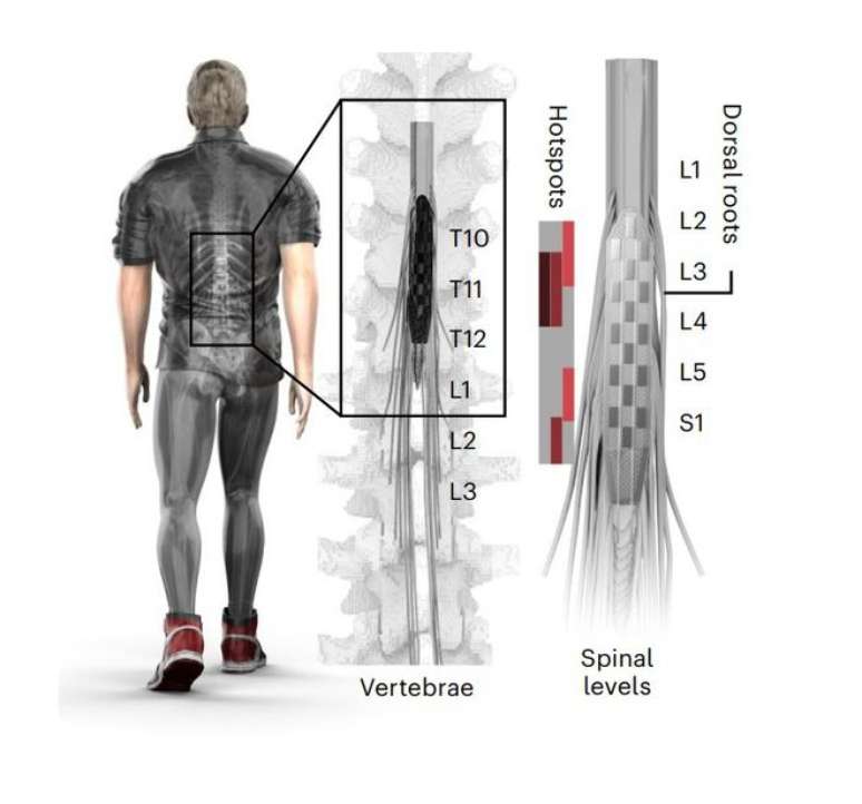 Implante na medula espinhal faz paciente com Parkinson voltar a andar (Imagem: Milekovic et al., 2023/Nature Medicine)