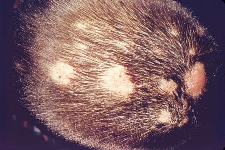 Remédio da baricitinibe, da Eli Lilly, pode tratar a perda de cabelo provocada pela alopecia (Imagem: Lucille K. Georg/CDC)