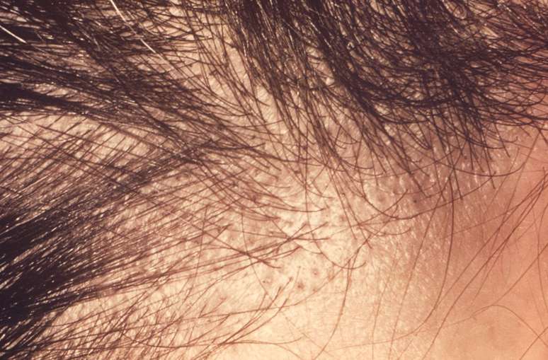 Após 36 semanas de tratamento, pacientes relatam melhora na alopecia com remédio aprovado pela Anvisa (Imagem: CDC/Dr. Lucille K. Georg)