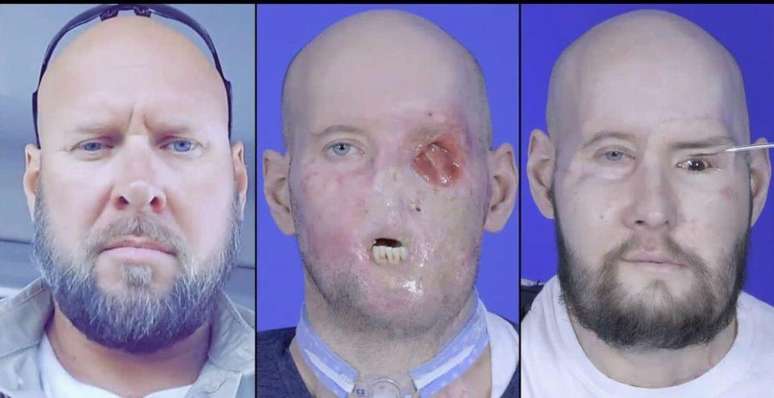 First successful complete face and eye transplant in North America