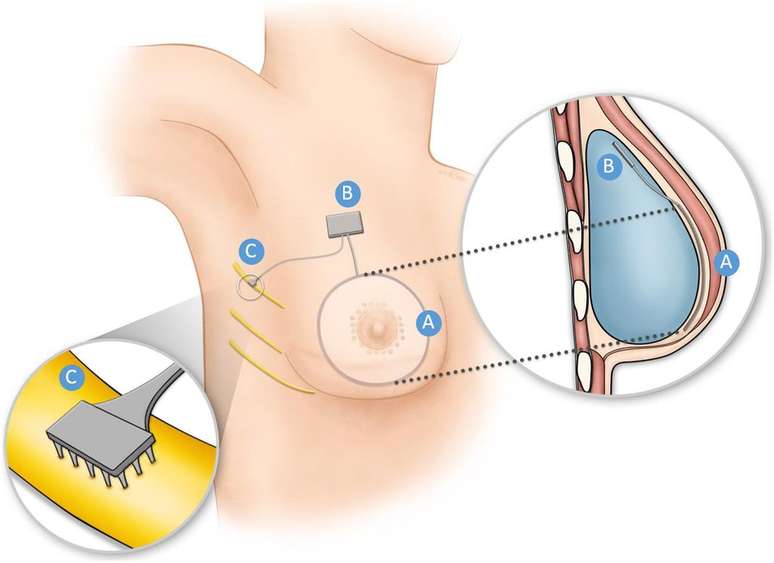 Esquema de como funcionará o "seio biônico", que usa eletrodos e nervos do corpo para devolver a sensação de toque ao peito reconstruido (Imagem: Lindau, Bensmaia/Frontiers in Neurorobotics)