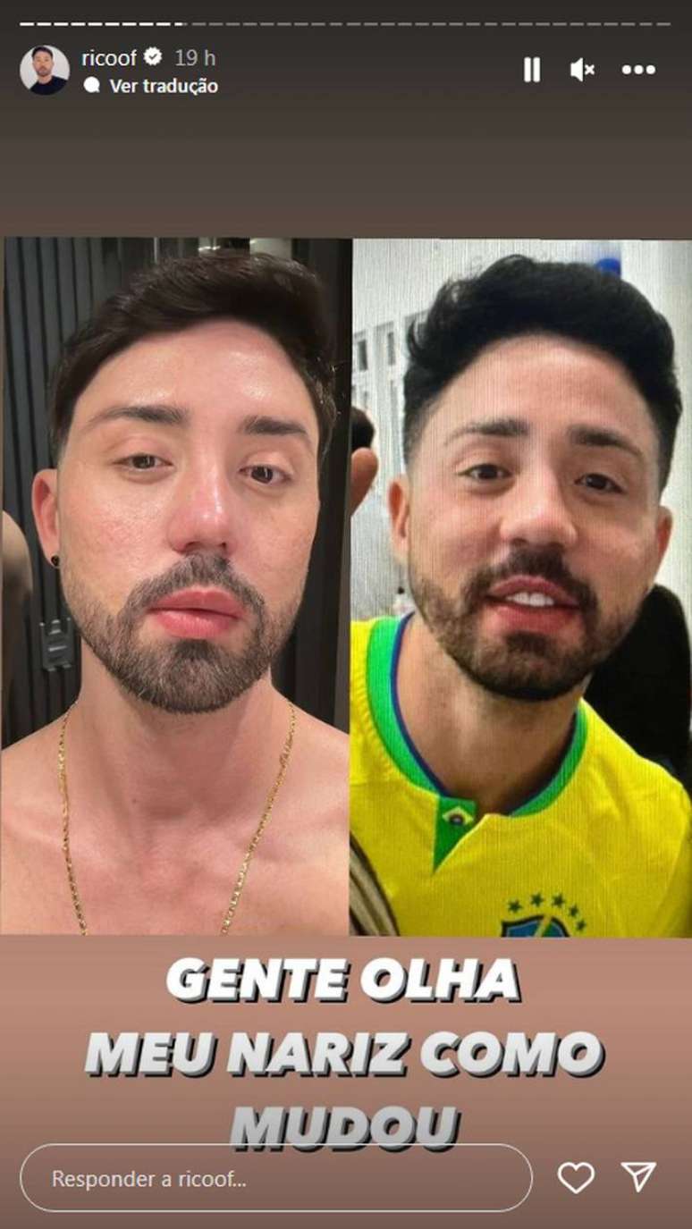 Rico Melquiades mostra resultado com 'antes e depois' de cirurgia plástica no nariz
