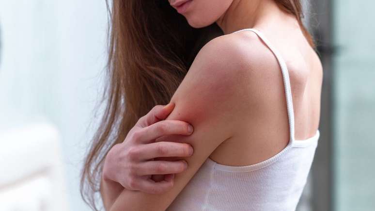 Evite as doenças de pele características do verão - Shutterstock
