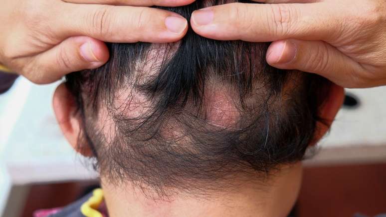 A alopecia areata é uma doença que provoca a queda severa de cabelo -