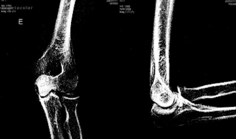 Exames de raio-x e de corpo de delito exibidos pelo Domingo Espetacular apontam para uma lesão corporal leve no cotovelo esquerdo da apresentadora