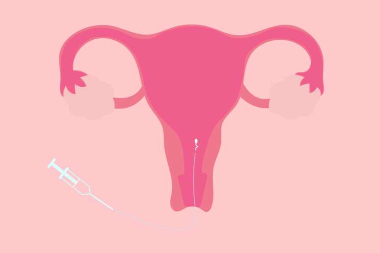 Inseminação intrauterina também pode ser combinada com inseminação intratubária 