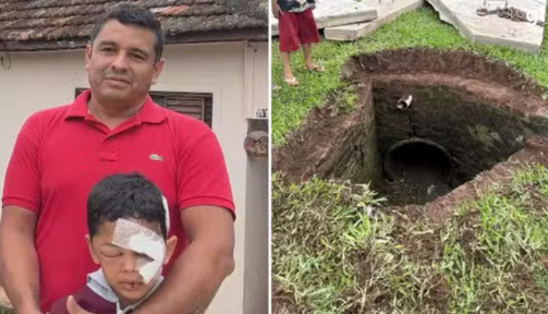 O menino teve vários ferimentos no rosto após a queda no bueiro