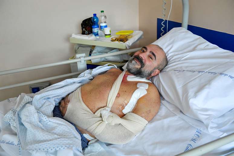 An Italian could regain the use of his hand after pioneering a nerve transplant from an amputated leg