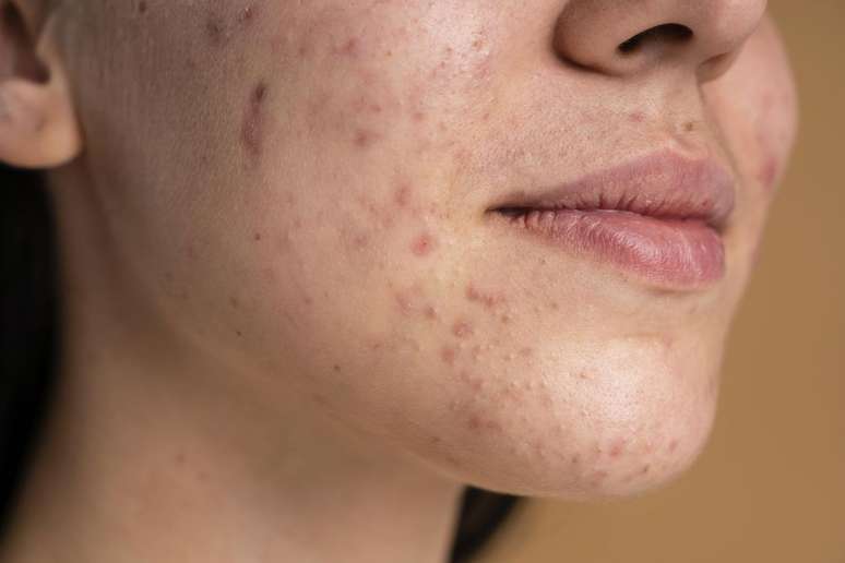 A acne é causada pelo bloqueio ou inflamação dos folículos pilosebáceos (Imagem: Freepik/Domínio Público)