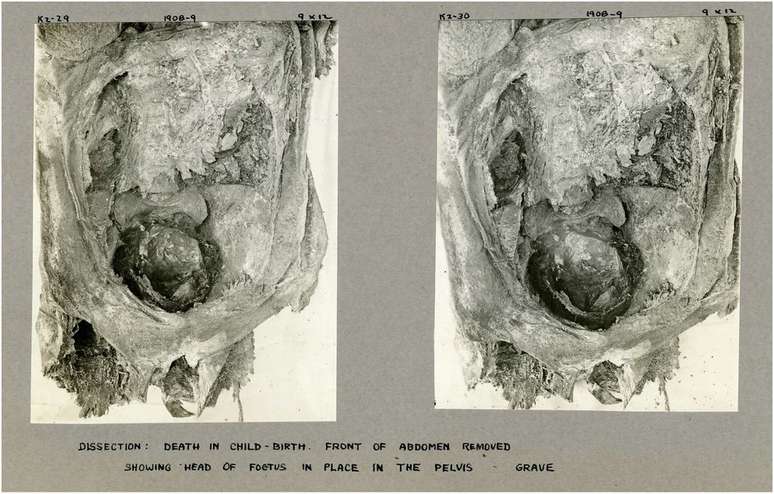Fotografia de 1908 da dissecação da múmia, mostrando a cabeça do feto ainda dentro da pelve da mãe (Imagem: Margolis, Hunt/International Journal of Osteoarchaeology)