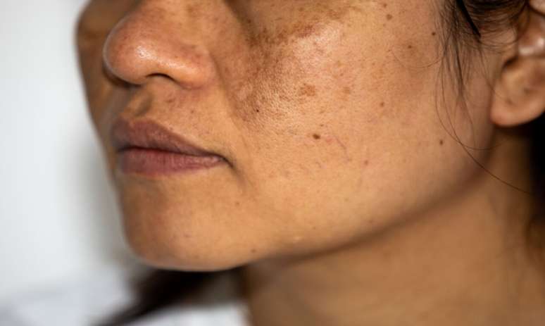 Melasma e sol: saiba como amenizar as manchas no verão