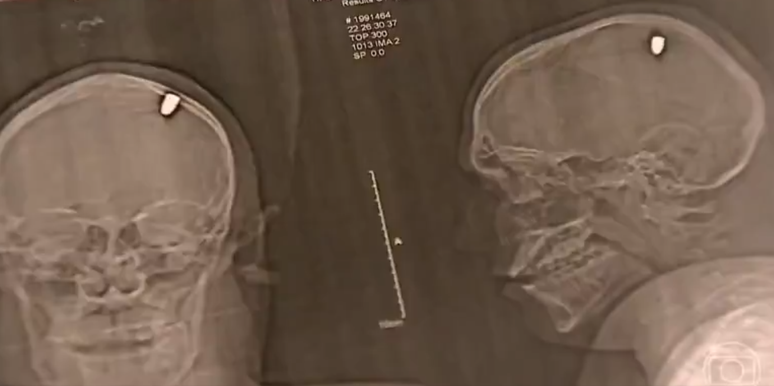 Tomografia detectou bala alojada no crânio