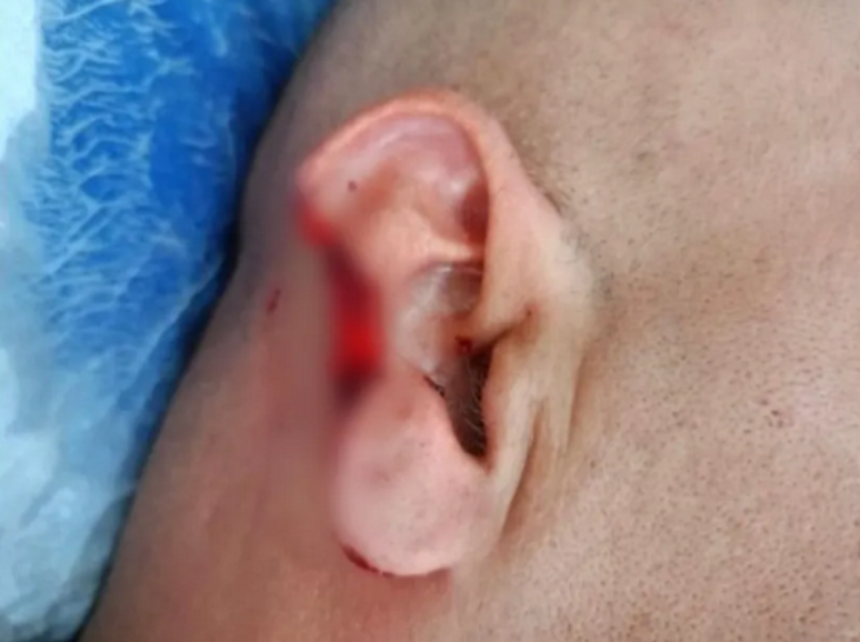 O policial teve parte da orelha arrancada