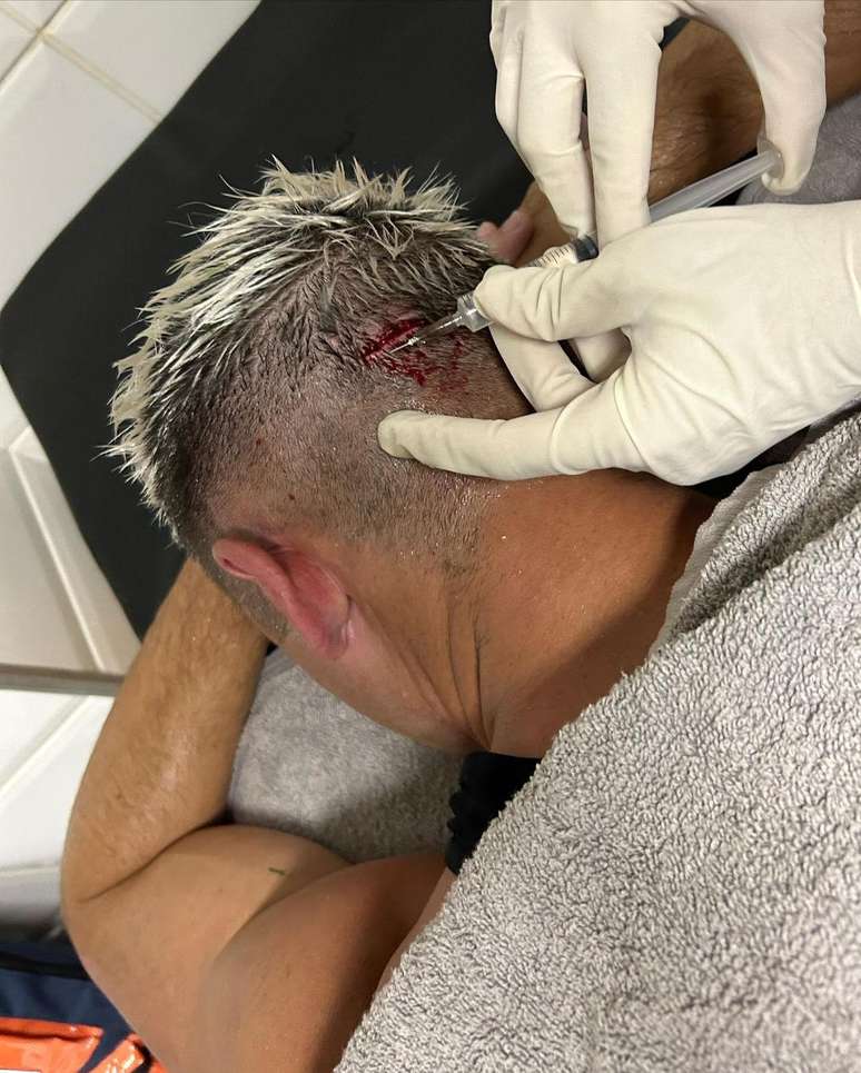 Capasso tem ferimento na cabeça após cotovelada no jogo contra o Boavista.