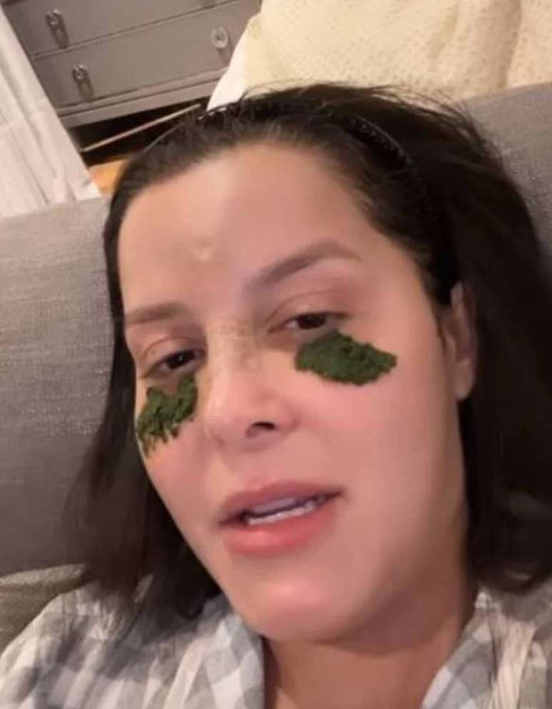A cantora Mara&iacute;sa usa mastruz para amenizar os hematomas na &aacute;rea dos olhos