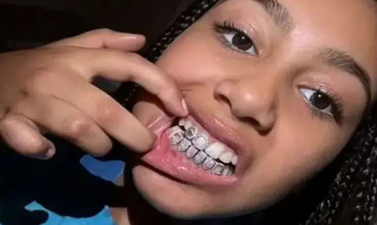 Filha de Kanye West exibe prótese de titânio: quais os riscos dos grillz?