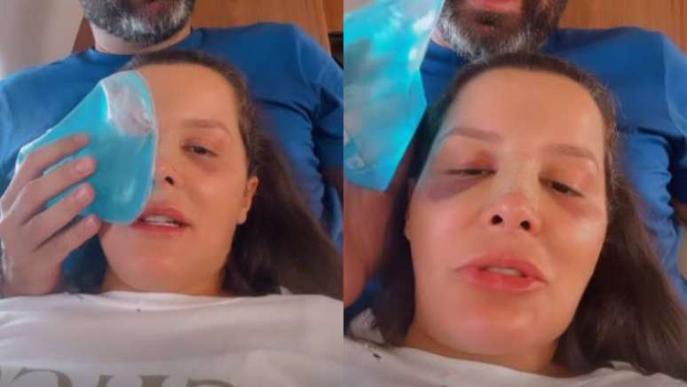 Maraisa mostra rosto com hematomas ap&oacute;s acidente em resort.