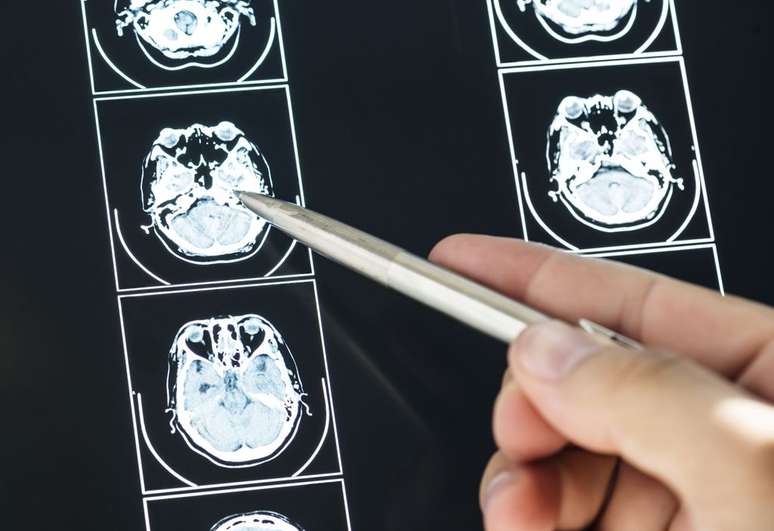 Através de ressonância magnética, foi possível identificar padrões do TDAH no cérebro, o que revelará muito sobre a condição (Imagem: Rawpixel/Envato)