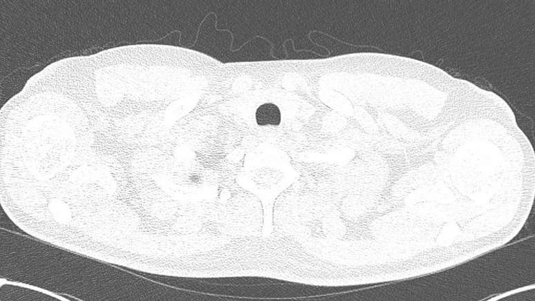 Mancha no pulmão foi sinal de que algo estava errado