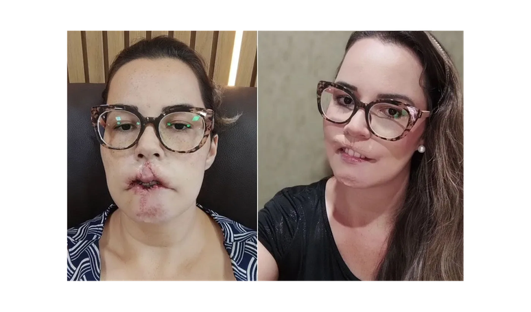 Shocking!  The influencer loses her lips and ends up with a deformed face after complications with lip repair