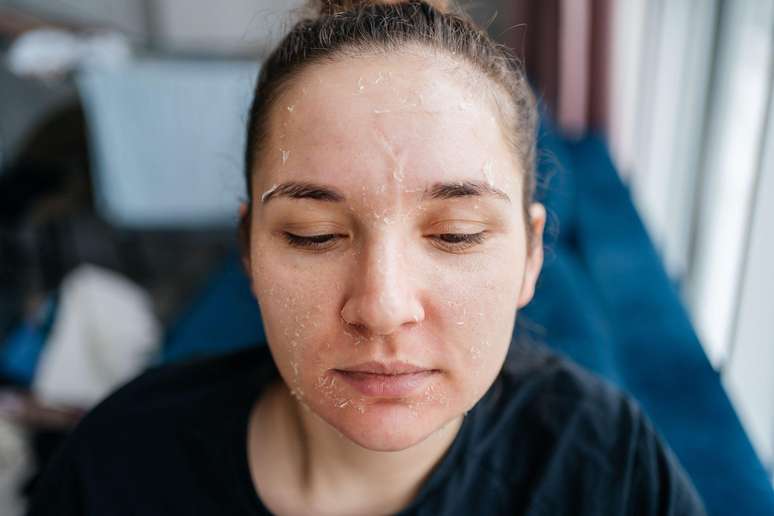 Apesar de as peles com acne geralmente tenderem a ser oleosas, a minha é seca em certas partes do rosto e irrita-se com alguns produtos
