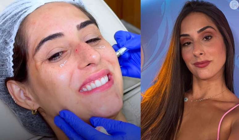 Deniziane realizou harmonização facial após 'BBB 24'.