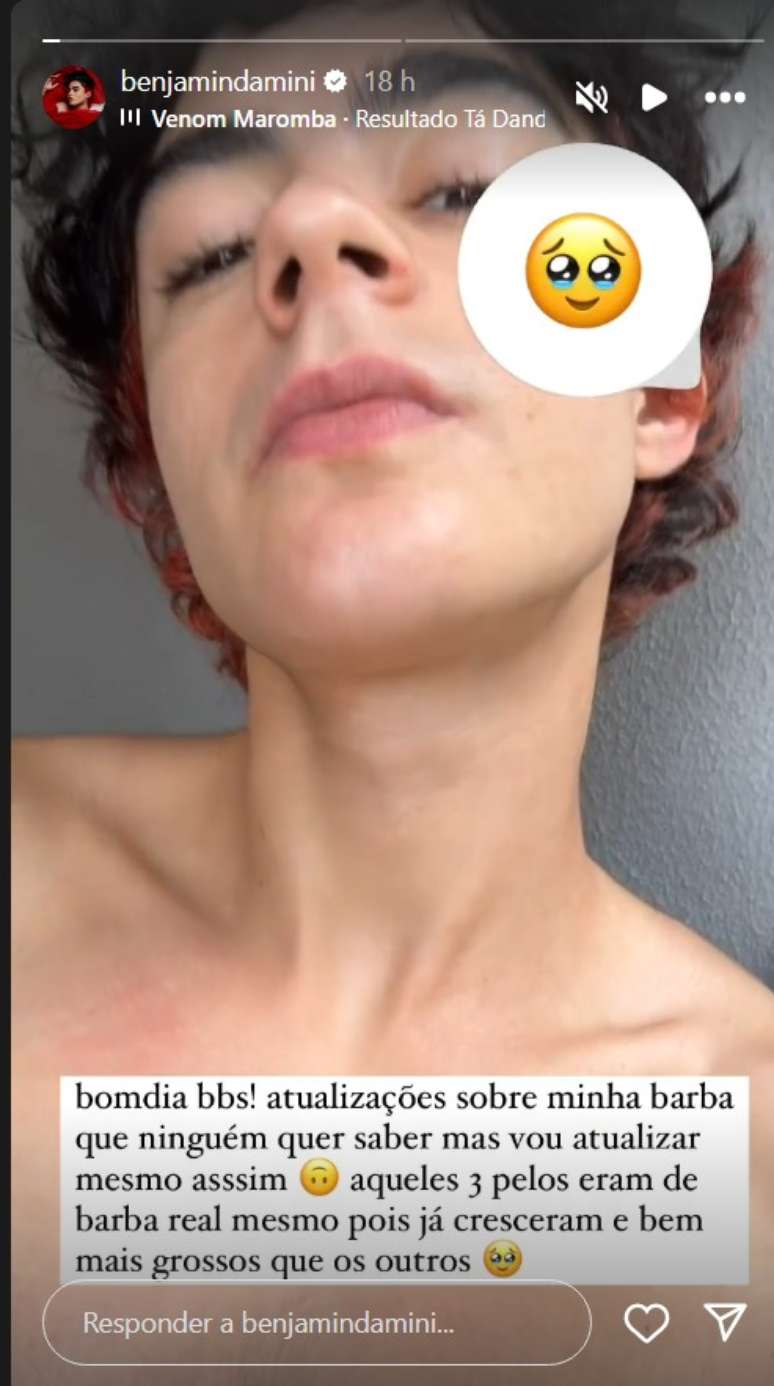 "Aqueles tr&ecirc;s pelos eram de barba real mesmo pois j&aacute; cresceram e bem mais grossos que os outros", disse Benjamin Damini no Instagram