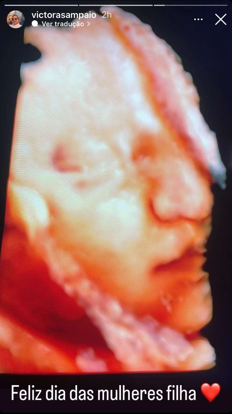 Fernanda Paes Leme’s boyfriend shows an ultrasound of his daughter Pilar’s face