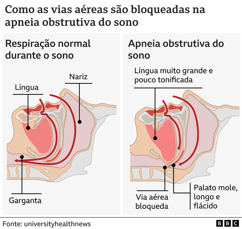 Ilustração mostra como funciona a apneia obstrutiva do sono