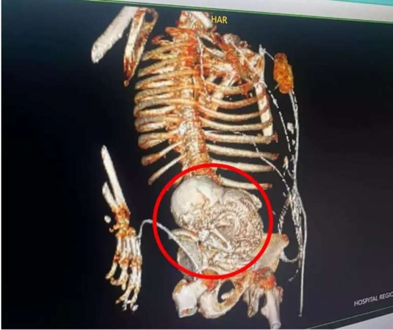 Feto mumificado no abdômen de paciente do Hospital Regional de Ponta Porã (MS)