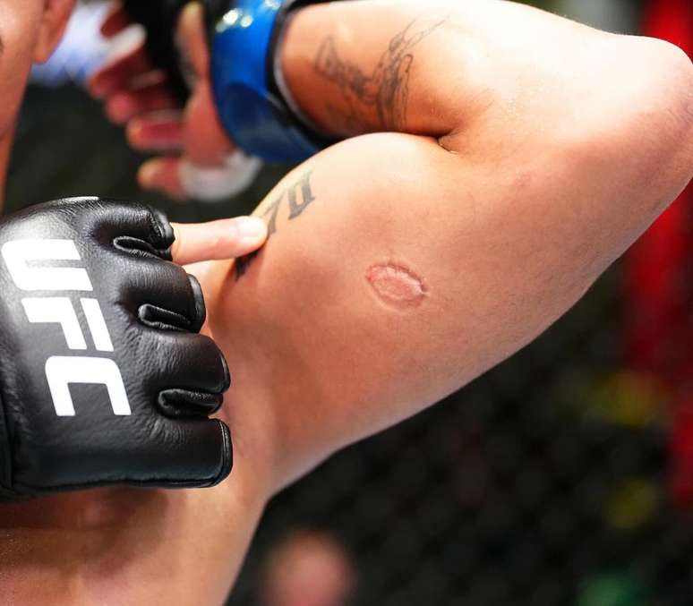 André Mascote levou mordida durante luta no UFC 