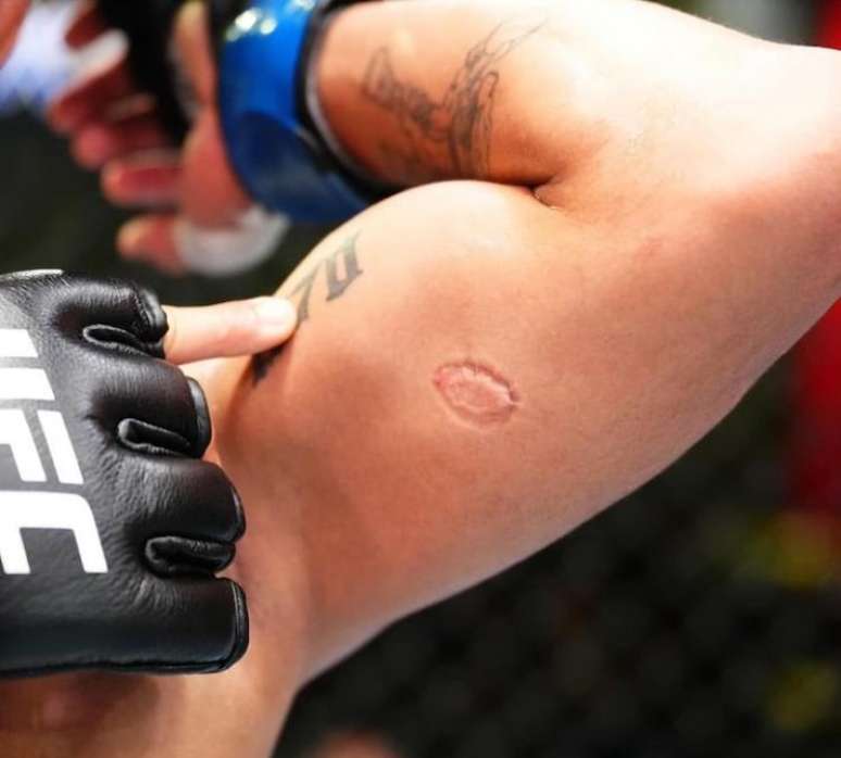 Brasileiro é mordido em luta do UFC e eterniza marca na pele.