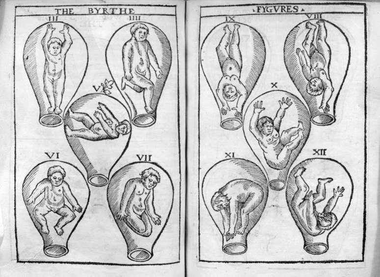 A ideia de que o útero causava histeria persistiu até o Renascimento