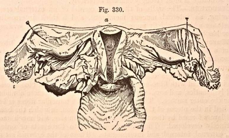 Em 1876, data desta gravura, a anatomia de um útero era um pouco mais clara e já se sabia que ele não vagava pelo corpo