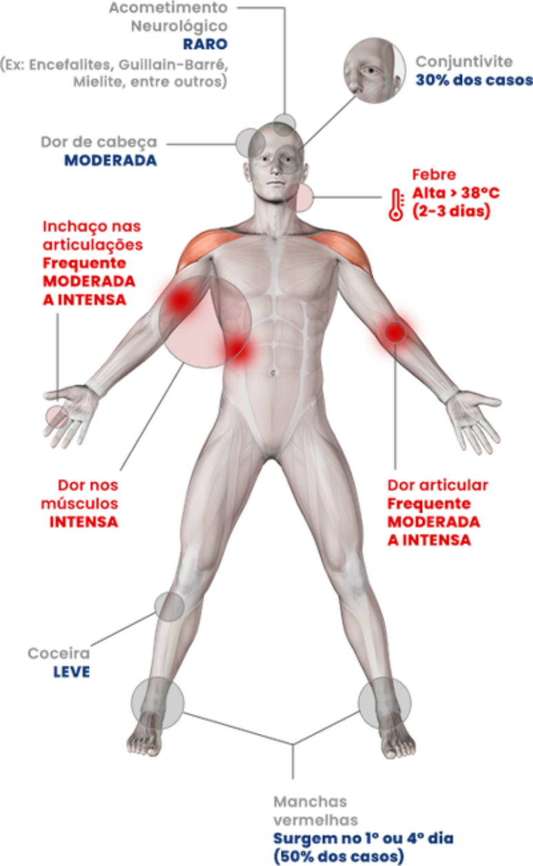 Imagem mostra principais sintomas da chikungunya
