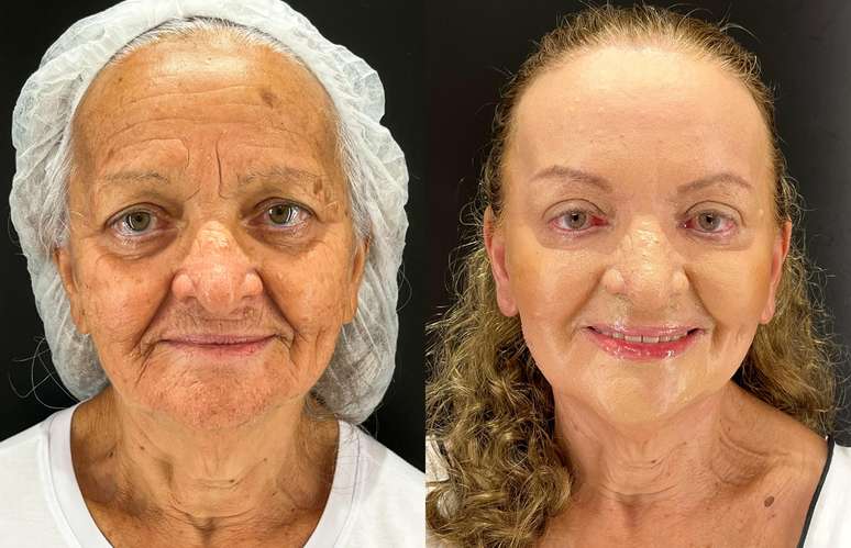 Antes e depois do tratamendo de Peeling de Fenol em Maria Ivone